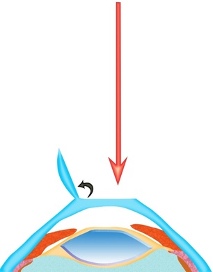 chirurgie réfractive par laser