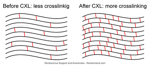 Les liaisons physico-chimiques entre les fibres de collagène avant et après CXL.